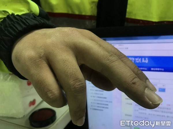 警察壓制過程手部不慎擦挫傷。 警察壓制過程手部不慎擦挫傷。