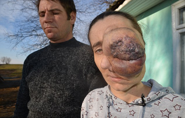 羅馬尼亞一女子眼旁長巨瘤 渴望切除重獲新生 羅馬尼亞一女子眼旁長巨瘤 渴望切除重獲新生