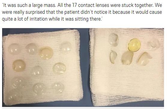 白內障手術夾出27片隱形眼鏡 白內障手術夾出27片隱形眼鏡