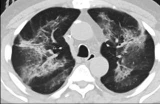 6�����S��CTƽ�߈D���@ʾë����Ӱ׃?y��u)�?sh��)׃���p�ȽY(ji��)��(g��u)Ť����(ͬһ����CTӰ��)