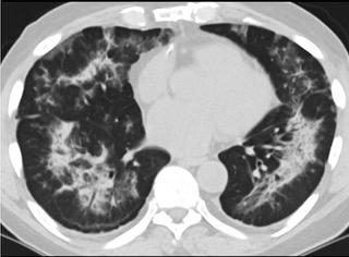 6�����S��CTƽ�߈D���@ʾë����Ӱ׃?y��u)�?sh��)׃���p�ȽY(ji��)��(g��u)Ť����(ͬһ����CTӰ��)